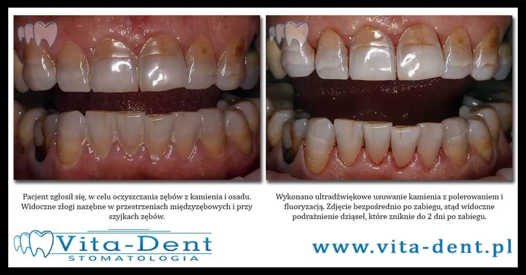 Dowiedz się co ile czasu można usuwać kamień nazębny: zalecenia ekspertów