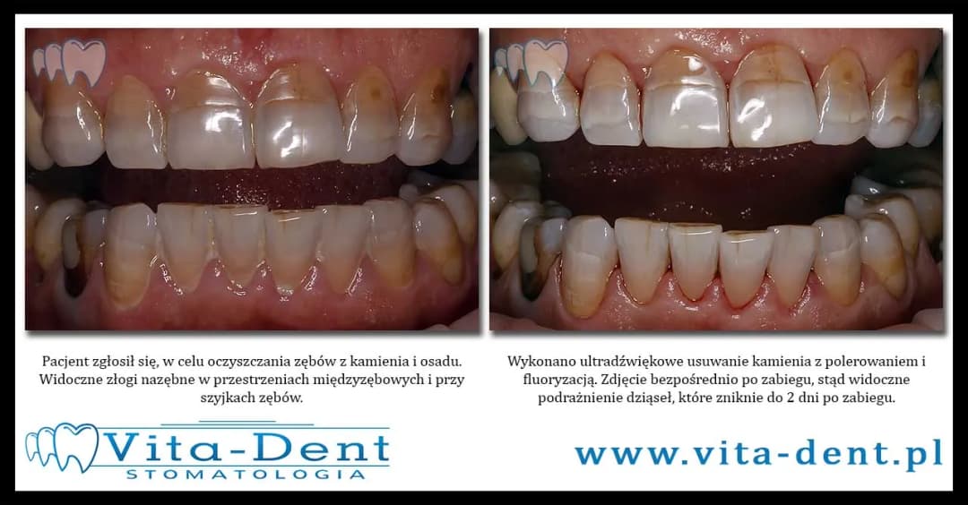 Dowiedz się co ile czasu można usuwać kamień nazębny: zalecenia ekspertów